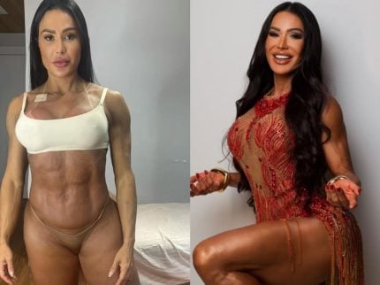 Gracyanne mostra antes e depois e explica ganho de 20 kg na balança após cirurgia