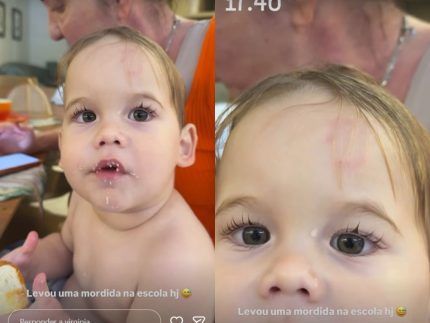 José Leonardo, filho de Virginia, é mordido na escola e influenciadora mostra hematoma
